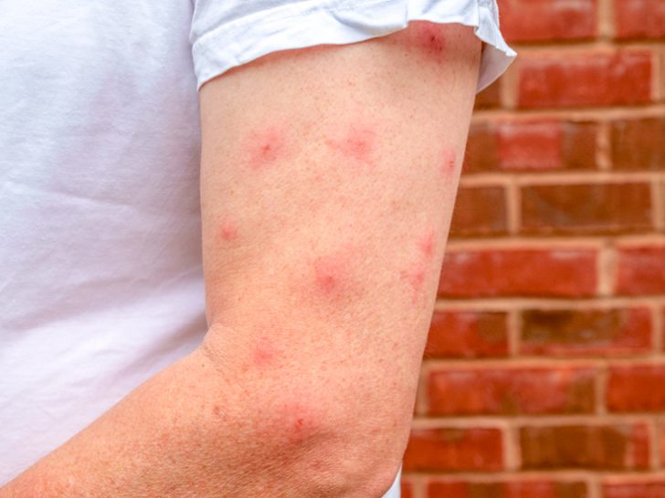 how-severe-is-the-allergy-to-mosquito-bites-locksmith-of-hearts